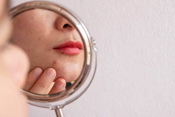 Does Collagen Help with Acne? What the Research Says