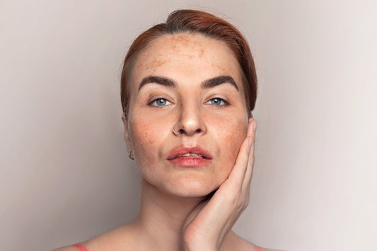 Custom Hydroquinone Cream For Stubborn Melasma