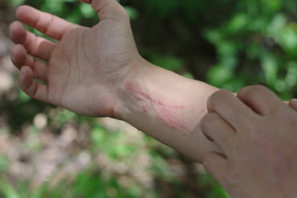 poison ivy rash on arm