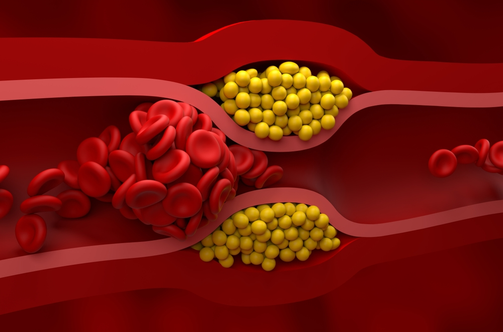 illustration of cholesterol blocking artery